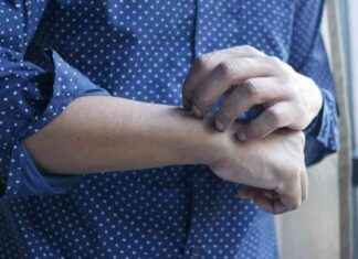 Cómo prevenir y aliviar la dermatitis atópica: consejos útiles news-14092024-070142