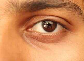 Enfermedades que causan ojeras aun durmiendo bien: ¡Descúbrelas ahora! news-17092024-054703